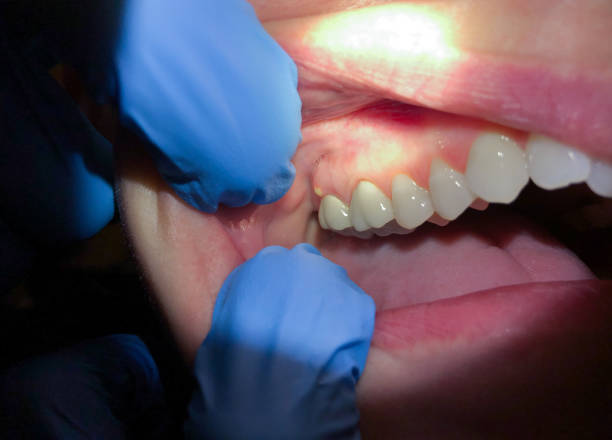 Best Emergency Denture Repair in Loughman, FL